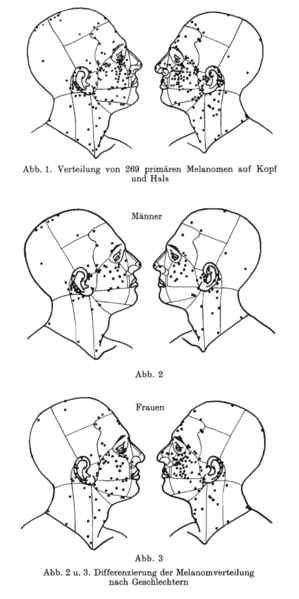 File:Distribution of occurrence of melanoma.png